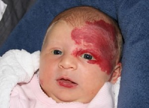 Hemangiomes Infantiles Apres Le Propanolol D Autres Betabloquants Plus Efficaces Et Plus Surs Neonat News Neuf Mois Pour Les Sages Femmes